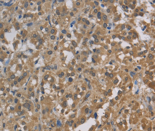 Иммуногистохимия, Cytochrome b5, ткань рака щитовидной железы человека