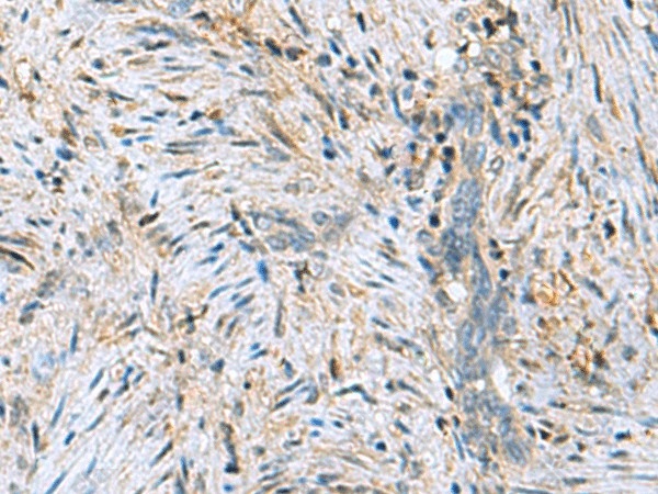 Иммуногистохимия, DNPH1, ткань рака шейки матки человека