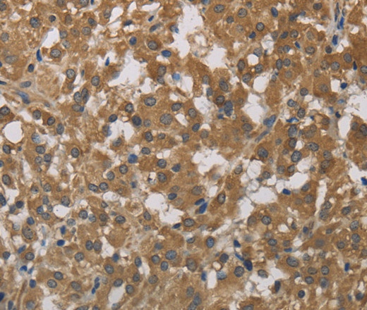 Иммуногистохимия, Cytochrome b5, ткань рака щитовидной железы человека