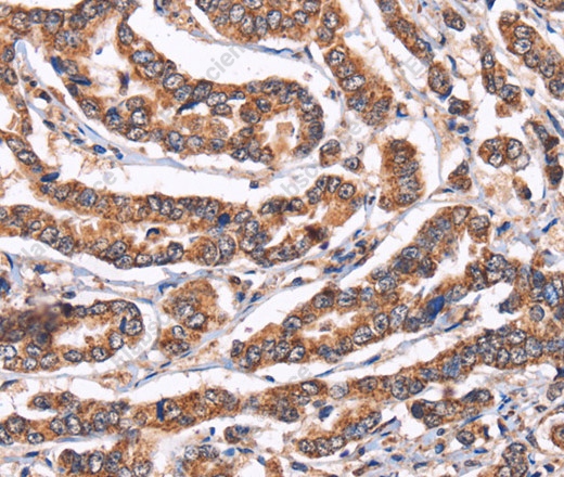 Иммуногистохимия, Cyclophilin F, ткань рака молочной железы человека