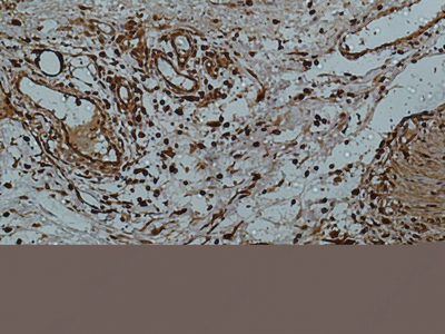 Иммуногистохимия, Galectin 3, ткань толстой кишки человека