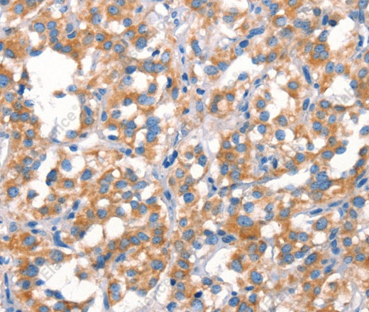 Иммуногистохимия, Cytochrome b, ткань рака щитовидной железы человека