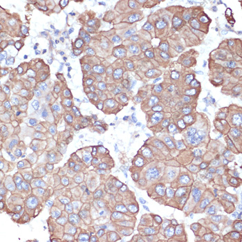 Иммуногистохимия, CytokeRatin-18, ткань рака печени человека