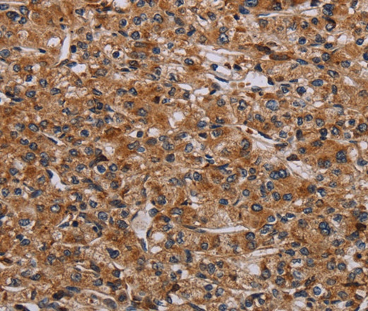 Иммуногистохимия, p70 S6 kinase beta, ткань рака предстательной железы человека