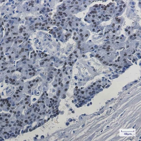 Иммуногистохимия, Estrogen Receptor alpha, ткань рака молочной железы человека