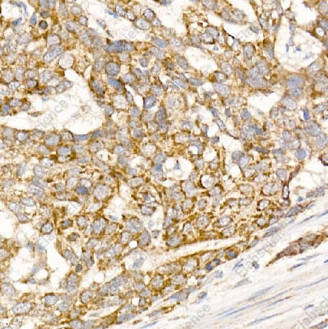 Иммуногистохимия, Glycerol kinase, ткань рака пищевода человека