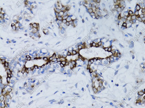 Иммуногистохимия, BRCA1, ткань рака молочной железы человека