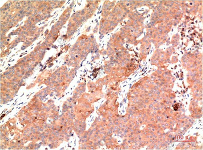 Иммуногистохимия, Epsilon Tubulin, ткань карциномы молочной железы человека