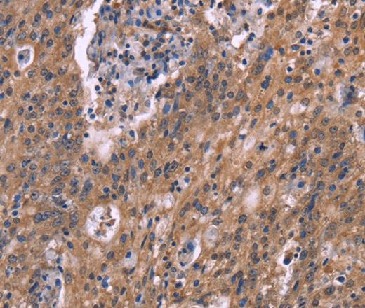 Иммуногистохимия, HSD11B2, ткань рака печени человека