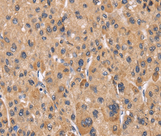 Иммуногистохимия, Cyclophilin F, ткань рака печени человека