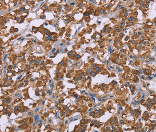 Иммуногистохимия, Cyclophilin F, ткань рака щитовидной железы человека