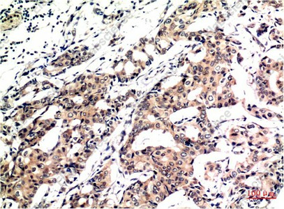 Иммуногистохимия, Ubiquitin, ткань карциномы молочной железы человека