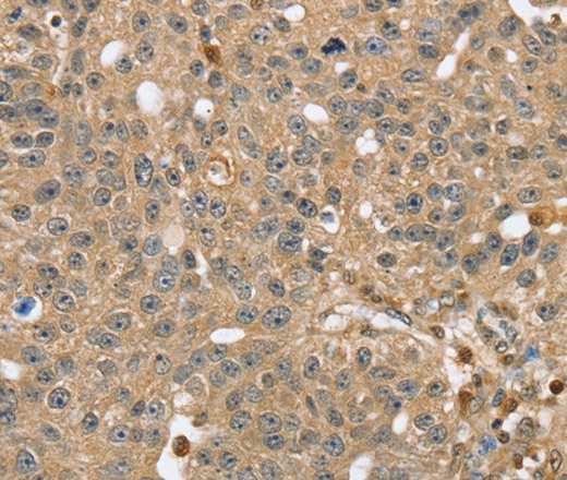Иммуногистохимия, RNH1, ткань рака молочной железы человека