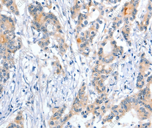 Иммуногистохимия, Placental Alkaline Phosphatase, ткань колоректального рака человека