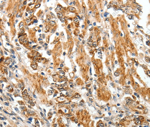 Иммуногистохимия, TGF β Receptor I, ткань рака желудка человека
