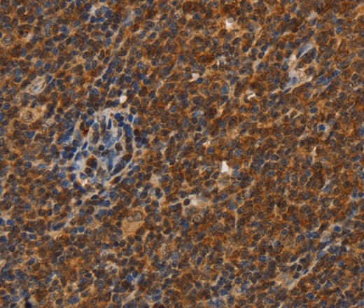 Иммуногистохимия, CDC34, ткань лимфомы человека