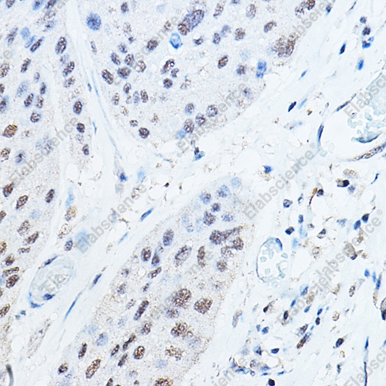 Иммуногистохимия, Ubiquitin, ткань рака пищевода человека