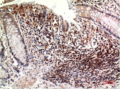 Иммуногистохимия, Epsilon Tubulin, ткань карциномы толстой кишки человека