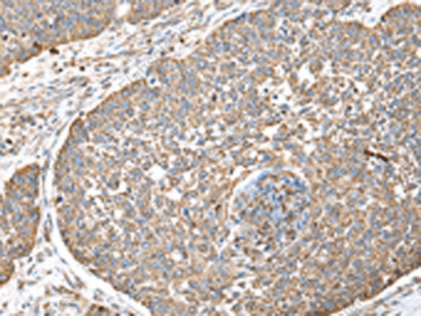 Иммуногистохимия, DPH7, ткань рака легкого человека