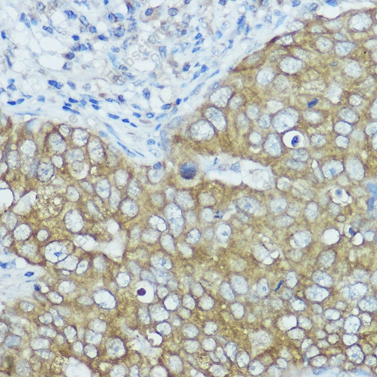 Иммуногистохимия, BSCL2, ткань рака молочной железы человека