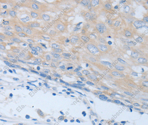 Иммуногистохимия, CHRNA7, ткань рака шейки матки человека