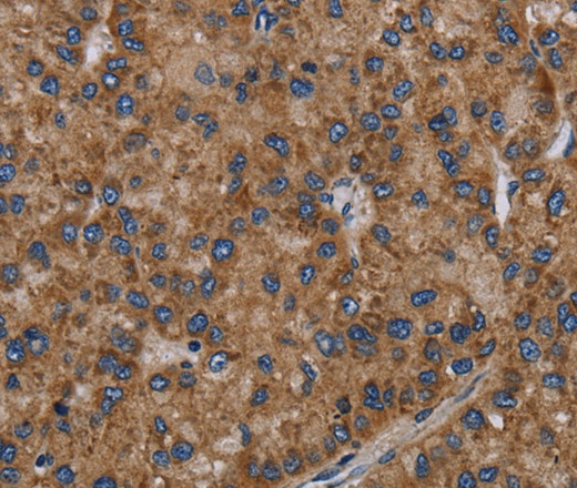 Иммуногистохимия, NECTIN2, ткань рака печени человека