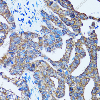 Иммуногистохимия, Caspase-3, ткань рака желудка человека