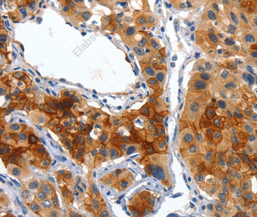 Иммуногистохимия, Placental Alkaline Phosphatase, ткань рака легкого человека