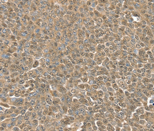 Иммуногистохимия, RNH1, ткань рака яичника человека