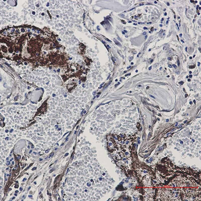 Иммуногистохимия, Thrombospondin 1, холангиокарцинома человека