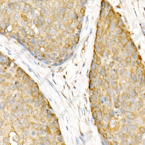 Иммуногистохимия, Hsp90β, ткань рака пищевода человека