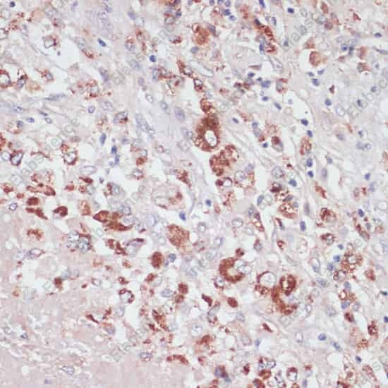 Иммуногистохимия, LYZ, ткань рака печени человека