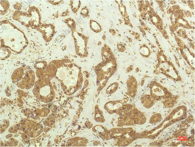 Иммуногистохимия, p70 S6 kinase alpha, ткань карциномы молочной железы человека