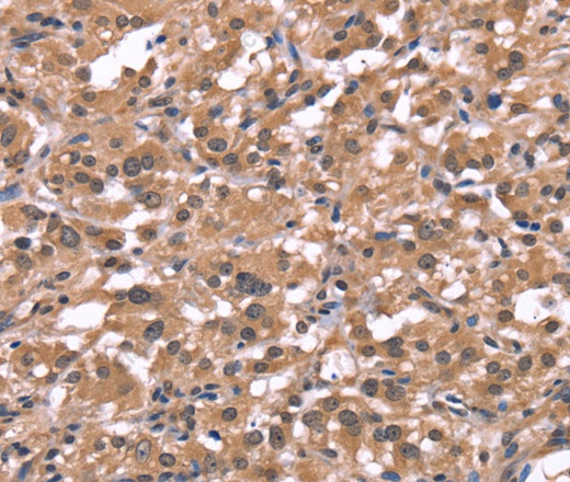 Иммуногистохимия, Histamine H1 Receptor, ткань рака щитовидной железы человека
