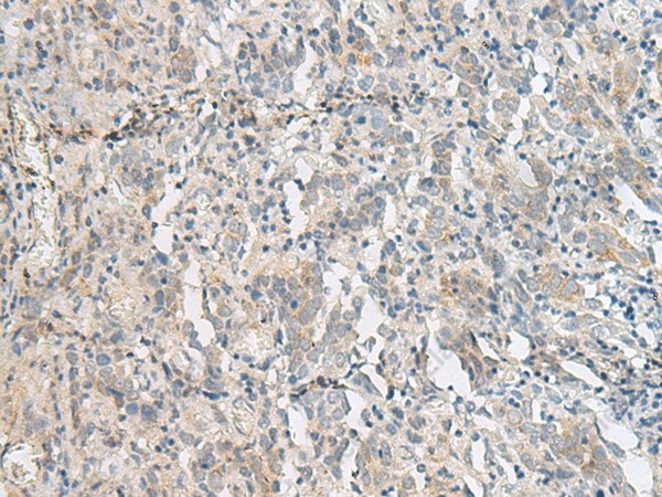 Иммуногистохимия, PCSK5, ткань рака шейки матки человека
