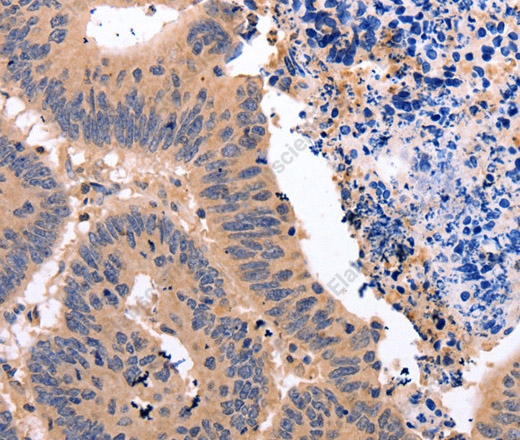 Иммуногистохимия, Glucocorticoid Receptor, ткань рака толстой кишки человека