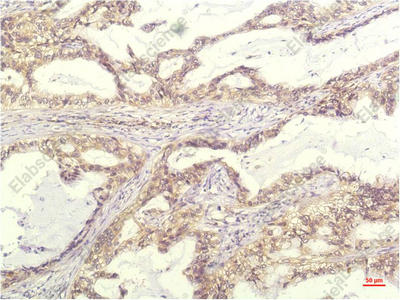 Иммуногистохимия, IL8, ткань карциномы легкого человека