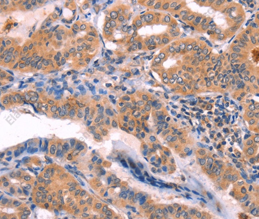 Иммуногистохимия, NCEH1, ткань рака щитовидной железы человека