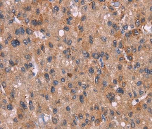 Иммуногистохимия, Histamine H3 Receptor, ткань рака печени человека