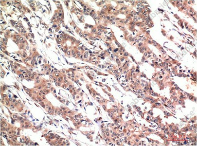 Иммуногистохимия, Phospho-STAT3 (Tyr705), ткань карциномы толстой кишки человека