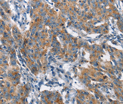 Иммуногистохимия, CHMP1A, ткань рака желудка человека