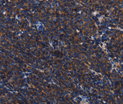 Иммуногистохимия, CD45, ткань лимфомы человека