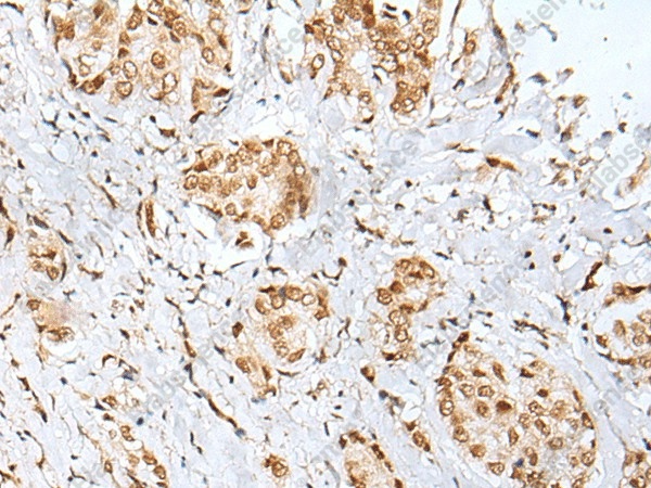 Иммуногистохимия, ZNF354A, ткань рака молочной железы человека