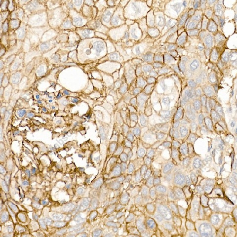 Иммуногистохимия, CD141/Thrombomodulin, ткань плоскоклеточной карциномы легкого человека