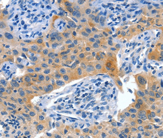 Иммуногистохимия, Placental Alkaline Phosphatase, ткань рака легкого человека