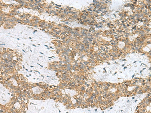 Иммуногистохимия, SKI, ткань рака молочной железы человека