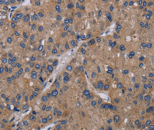Иммуногистохимия, NECTIN4, ткань рака печени человека
