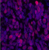 Иммунофлуоресценция, Acetyl-Histone H3 (Lys9), ткань рака легкого человека