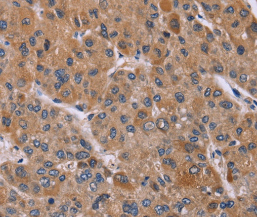 Иммуногистохимия, Cyclophilin F, ткань рака печени человека