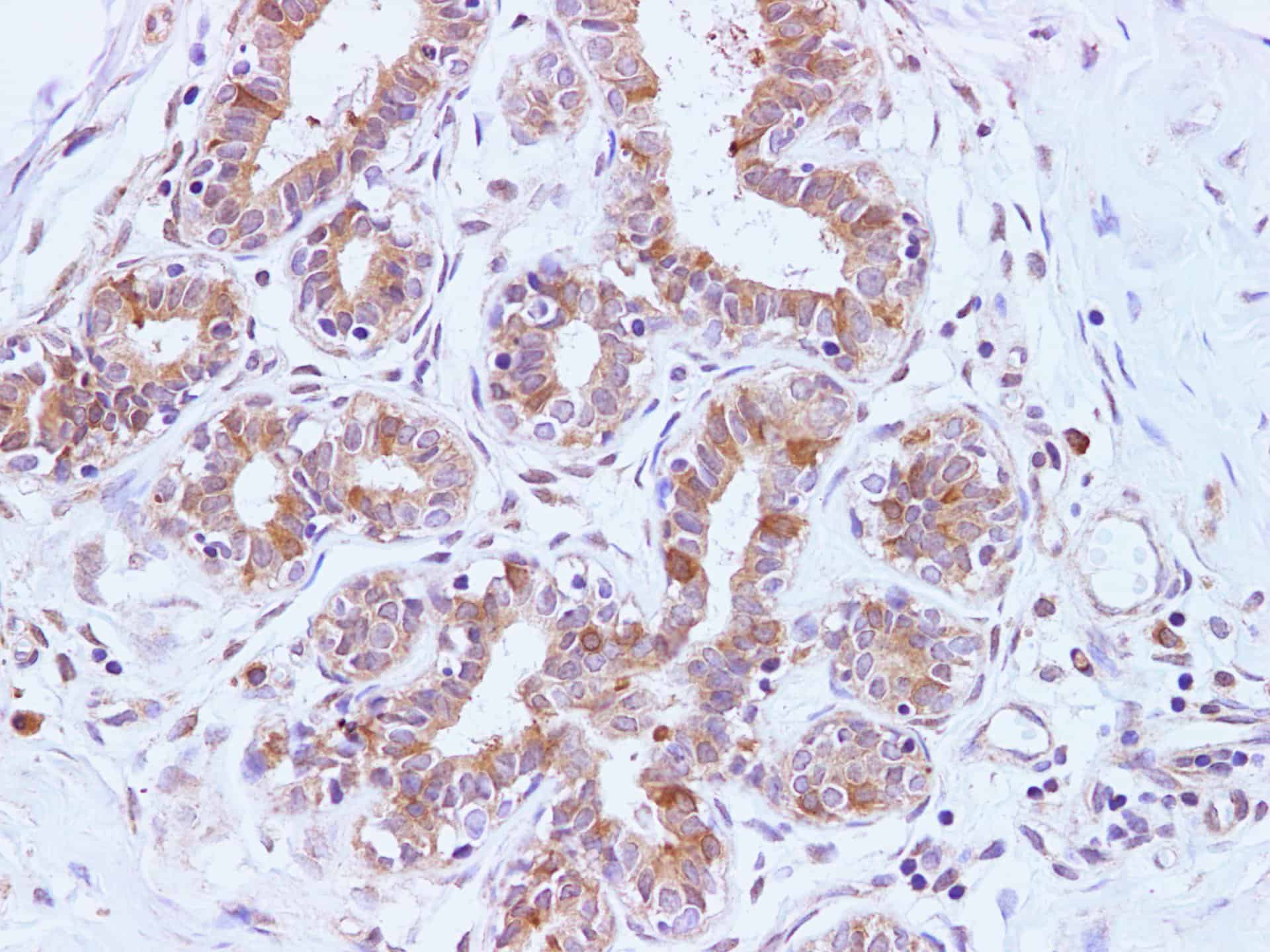 Иммуногистохимия, BRCA2, ткань молочной железы человека